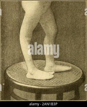 Moderne Diagnose und Behandlung von Erkrankungen der Kinder; eine Abhandlung über die medizinischen und chirurgischen Erkrankungen der Kindheit in der Kindheit . Sie hält sich in der Regel einige Wochen oder Monate auf Lebenszeit fort. Die per-manent gelähmten Strukturen beginnen bald zu verschwenden und untergößige Degeneration zu vergeuden. Die Muskeln sind flabby und dünne und theartikuläre Bänder, die so locker sind, dass die Extremität länglich und anfällig für das Ausrutschen aus dem Gelenk erscheint. Häufig kommt es auch zu Atrophie der Knochen. Als unmittelbare Folge der Atrophie der erkrankten Teilsand wirkt die nicht gegensätzliche Aktion (Kontraktion) der nicht paralyzedantagonistischen Muskeln, die Affekt Stockfoto