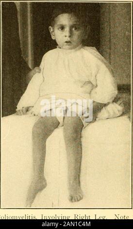 Moderne Diagnose und Behandlung von Erkrankungen des Kindes; eine Abhandlung über die medizinischen und chirurgischen Erkrankungen der Kindheit im Kinderalter . D auch in andere Regionen der Kordel und sogar in die Medulla und pons - und zwar die Vielfalt der Symptomatologie. Nach der Absetzung des akuten Entzündungsvorgangs bleiben einige der betroffenen Teile der Schnur in der Regel (es gibt einen Lichtbogen, aber nur wenige,;[.,;,!;Ausnahmen) mehr oder weniger dauerhaft verletzt (atrophiert), und es hängt vom Ausmaß dieser permanenten und nicht uponder ursprünglichen Läsion ab, von der der weitere Verlauf der Krankheit abhängt. Man ist sich nun allgemein einig, dass das d Stockfoto