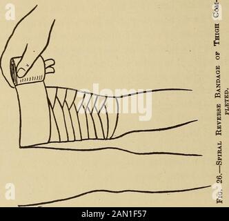 Der Hausmediziner, eine beliebte Arbeit zur Behandlung von Krankheiten . Tter-Material ist nicht zur Hand. Bandages Bandaging ist eine Kunst, die nur durch praktische Unterweisung und Erfahrung in jedem Maß an Perfektion erworben werden kann. Einige nützliche Hinweise gibt es aber vielleicht den Unerfahrenen. Baumwolltuch oder Muslin, gebleicht oder ungebleicht, ist für Bandagen üblich; auch Gaze (nicht so effektiv ein Umkleiderbutter viel leichter zu verwenden), die weicher und bequemer ist und am besten auf den Gebrauch des Anfängers abgestimmt ist. Eine Binde kann nicht richtig aufgesetzt werden, es sei denn, sie wird zuerst gerollt. Ein Verband für t Stockfoto