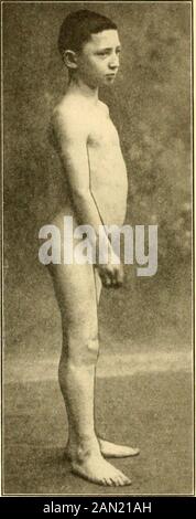 Moderne Diagnose und Behandlung von Krankheiten der Kinder; eine Abhandlung über die medizinischen und chirurgischen Erkrankungen der Kindheit . E Hände und Füße) . Die Steifigkeit wird schnell steif, platinenartig und sehr schmerzhaft, so viel störend J . . mit anderen, dass die verschiedenen Funktionen des Körpers (Maskierung, Entglutition, Funktionen von J V Grad des Körpers, Atmung usw.) gestört werden und der Zustand der Gehirnsteifigkeit groß ist. In einigen Fällen überwiegt das kutane Ödem (Dcrmatomyosi-Hs), in anderen Fällen ein hämorrhagischer Zustand der Haut und der Schleimhautmembran (Polymyositis-Saum Stockfoto