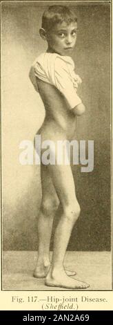Moderne Diagnose und Behandlung von Erkrankungen der Kinder; eine Abhandlung über die medizinischen und chirurgischen Erkrankungen der Kindheit im Kinderalter . Thelimbs, die parallel zueinander herausgeführt wurden, gibt es eine alwayskompensatorische Lordose der Thelumbar-Region. Diese Lordosisverschwindet beim Biegen der af-eingesenkten Extremität an der Hüfte in den Winkel, in dem sie von der kontraktedmuskulatur heldgebeugt wird. Die Intensität der Schmerzen variiert. Es ist in der Regel worsafter Manipulation und Müdigkeit, und in der Nacht. Es weckt das Kind mit einem Schrei aus dem itsound Schlaf (Schmerzen beim Anlassen). Der Schmerz wird auf das Knie oder auf andere Teile suppl bezogen Stockfoto