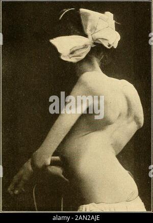 Moderne Diagnose und Behandlung von Krankheiten der Kinder; eine Abhandlung über die medizinischen und chirurgischen Erkrankungen der Kindheit . Verstellung: In der Regel unter Einbeziehung des Oberschenkelkopfes, seltener des Acetab-ulums; 2, des Arthritis- oder Suppurationsstadiums, an dem alle Gelenkstrukturen beteiligt sind; Und 3, das Stadium der Desintegration und Absorption des Kopfes und manchmal des Halses des Oberschenkels und des oberen und hinteren Teils des Acetabulums, wobei der Oberschenkelkopf nach oben und Backwardupon die Dorsum ilii zurückwandert. Gleichzeitig mit dem Beginn der ersten Phase des Patho- CO Stockfoto