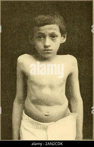 Moderne Diagnose und Behandlung von Krankheiten der Kinder; eine Abhandlung über die medizinischen und chirurgischen Erkrankungen der Kindheit . Spondylitis. Gibbus (12 Jahre alt).(Sheffield.) brse sind erkrankt, es besteht die Gefahr, dass der Kopf zwischen Atlas und Achse, seltener zwischen Theokiput und Atlas und Deatli durch Druck auf die Schnur verschoben wird. Die deständige Deformität bei der Zervixspondylitis besteht in der Regel in der Verdickung und Verbreiterung des Halses und dem sinken des Kopfes auf den Schultern. Bei der dorsalen Spondylitis unterscheidet sich die Verteilung der Schmerzen von Dorea]was mit dem Partiku Stockfoto