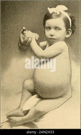 Moderne Diagnose und Behandlung von Erkrankungen der Kinder; eine Abhandlung über die medizinischen und chirurgischen Erkrankungen der Kindheit der Kindheit . die Vererberung ist das Ergebnis der Verbreitung von Tuberkeln über dem Peritoneum, Omentum und angrenzenden Strukturen. Die durch ihre Anwesenheit angeregte Inflammation führt zu einer serofibrinösen orhämorrhagischen Exsudation mit allmählicher Agglutination der Entzündungsportionen, Kaseation und Ulzeration. Bei der postmortalen Untersuchung von Fällen, die lange Zeit andauern, wird in der Regel die Beteiligung der mesenterischen und retroperitonealen Drüsen, die Fettdegeneration der Leber, die Tuberkulose der Lunge und p festgestellt Stockfoto