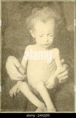 Moderne Diagnose und Behandlung von Erkrankungen der Kinder; eine Abhandlung über die medizinischen und chirurgischen Erkrankungen der Kindheit in der Kindheit. Prolange Exspiration, eingehängte Stimmfritus;feine, grobe und crepitantrale und Bronchialatmung. Hinzu kommen möglicherweise die physikalischen Zeichen trockener oder serohemor-rhagischer Pleurisie (siehe Seite275), die häufig ac-Unternehmen phthisis pul-monalis. Wo sich Kavitisesare bilden, bestehen die körperlichen Zeichen aus kavernöser Atmung, Bronchophonie oder Pektoriloquie. Die Schlagerresonanz ist amphorisch, wenn die Wände um den Hohlraum dünn und angespannt sind;Riss-Topf-Sound, wenn der Stockfoto