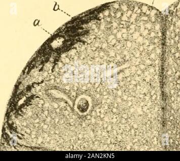 Moderne Diagnose und Behandlung von Krankheiten der Kinder; eine Abhandlung über die medizinischen und chirurgischen Erkrankungen der Kindheit im Kinderalter . vor allem die Wunden der Nation sollten sorgsam behandelt werden. Sicher ist, dass latente Tuberkulose gelegentlich durch Impfung aufleuchtet, Und diese Knollenkulose wurde in sehr außergewöhnlichen Fällen als von Tuberkelbacilli geimpft festgestellt, es ist absolut festgelegt, dass die meisten Fälle von Tuberkulose nach der Impfung theresult einer direkten Bacillarinfektion durch eine ungeschützte Impfungswunde sind. Pflege der impfen Ionenwunde Stockfoto