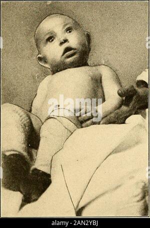 Moderne Diagnose und Behandlung von Erkrankungen der Kinder; eine Abhandlung über die medizinischen und chirurgischen Erkrankungen der Kindheit der Kindheit von Säuglingsanfall . hyl-Chlorid und Äther (Drop-by-Drop-Methode) sollten theanästhetisch der Wahl sein, und primär in der Präferenz für tiefe Anes-Thesen. Die zu verwendenden Instrumente sollten sorgfältig sterilisiert werden, und das Einsatzgebiet und alles, was in Kontakt kommt, sollten so aseptisch wie möglich sein. Vor Beginn der Operation sollte der Chirurg die Effizienz und die Gesamtheit seiner Anordnungen testen und dafür sorgen, dass er mit all diesen Medikamenten (Peroxid Wasserstoff, s. Stockfoto