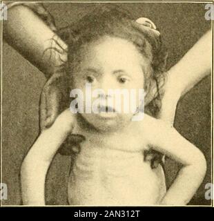 Moderne Diagnose und Behandlung von Erkrankungen der Kinder; eine Abhandlung über die medizinischen und chirurgischen Erkrankungen der Kindheit der Kindheit . Rhinopharynx ist normalerweise richin lymphoid oder adenoid Gewebewinde trägt den Namen naso-Pharyngeal oder Luschkas tonsil. Wie die auzialen Mandeln ist auch Thelatter häufigen Entzündungsangriffen mit zweithäriger Hypertrophie ausgesetzt. Immer wenn das hypertrophite Adenounteasumes solche Proportionen wie das mehr oder weniger den nasopharyn-gealen Raum füllt und die Nasenatmung behindert, entsteht ein pathognomonisches klinisches 244 ERKRANKUNGEN DER ATEMWEGE. Das Syndrom entwickelt sich jedoch Stockfoto