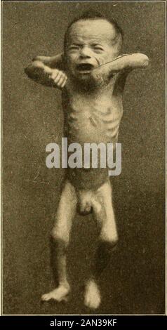 Moderne Diagnose und Behandlung von Erkrankungen des Kindes; eine Abhandlung über die medizinischen und chirurgischen Erkrankungen der Kindheit im Kinderalter . sehr gut, und kontrastiert stronglyJefShtn wtn tne Persistent l'ss des Gewichts. Die Zunge ist andflabby beschichtet, ihre Ränder sind rot und von den Zähnen oder Zahnfleisch eingerückt, und hier und dort von einer aphthösen Ablagerung bedeckt. Leichte Indisctionen in der Ernährung werden sofort von Erbrechen und Durchfall gefolgt. Die chemische Untersuchung des Inhalts der Stomachschliesst eine deutliche Abnahme der Salzsäure auf. Der Verlauf einer chronischen Gastroenterokolitis variiert in Individualfällen Stockfoto