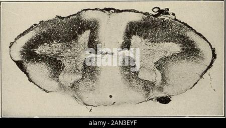 Nervöse und psychische Erkrankungen. Abb. 198.. Abb. 199. Abb. 197, 198 und 199.-Abschnitte aus drei Rückenmark, die Degenerationen durch perniziöse Anämie zeigen (Billings). Cipally in der weißen Schnabelmaterie gelegen, und zeigen eine dezidierte Tendenz, hauptsächlich die hintere Hälfte zu beeinflussen, was zu einer Gruppe VON ERKRANKUNGEN DER WEISSEN SCHNABELMASSE führt. 469 Symptome, die auf den hinteren und lateralen Trakt verweisen. In einigen Haltungen ist jedoch der vordere Teil der Schnur und sogar die Graumatte beteiligt. Durch experimentell verursachte Anämie im Hirnschnur Massaro, Sciciliano und Soukhanoff ha Stockfoto