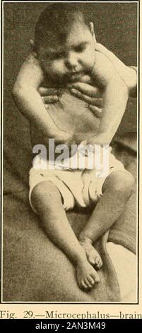 Moderne Diagnose und Behandlung von Erkrankungen der Kinder; eine Abhandlung über die medizinischen und chirurgischen Erkrankungen der Kindheit in der Kindheit (z. B. mehrere Zersplitterungs- und Verstaus). 4. Extra- oder intraabdominaler Druck durch Pelvicdeformitäten, Tumoren usw. (z. B. Talipes). 5. Einengung durch Fruchtbanden (z. B. Amputationen). ANGEBORENE FEHLBILDUNGEN DES KOPFES.MICROCEPHALUS. Wir unterscheiden zwei Varietätsvon Mikrozephalus: Eine, die als echte Gehirnerschütterung auftritt und das Ergebnis einer antenatalstrukturellen Erkrankung des Gehirns ist (Entzündung, Sklerose, Cysticdegeneration); die Stockfoto