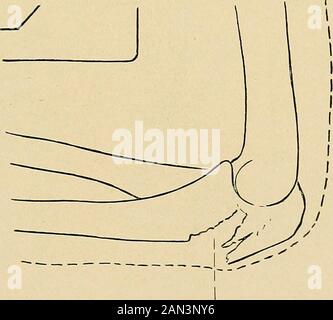 Die Behandlung von Frakturen . Abb. 271.-Zeigt Beziehungen zwischen Olecranon und Ellenbogengelenk; praktisch alle Brüche sind innerartikulär. Fraktursitz. Abb. 272.-Splitterfraktur von Olecranon ohne große Verdrängung (Massachusetts Gen-eral Hospital, 1536. Röntgenverfolgung). Oder erweitert - bei Biegung ist die Trennung größer als bei ifExtended (siehe Abb. 276); die Menge an Synovialflüssigkeit und Blutbluten im Gelenk - je größer die Flüssigkeitsmenge ist, desto größer werden 212 BRÜCHE DER KNOCHEN DES UNTERARMS, die Trennung der Bruchstücke sein. Die Beweglichkeit der Fragmentsdes Olecranons ist bestimmt Stockfoto