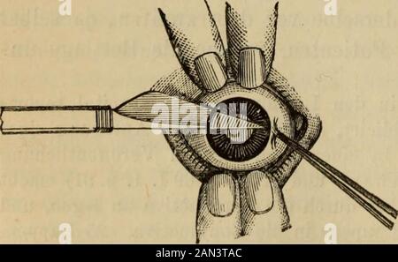 Das Handbuch der Augenheilkunde . hrend der Nachtservierungen, bei Tage liegen wir einen infachen Schutzverband an; mit dem-selben Darf der Krankheit auch ein oder zwei Stunden des Tages aufsteigen.Nach acht oder mehr Tagen des normalen Heilungsverlaufs e Kranke a. 91), später trägt er einen Punkt Brille, mit der er an der Ende der zwei oder Anfang der drintenWoche, je nach der Empfindlichkeit des Auges gegen Licht, ausehen kann. Hornhautschnitt nach oben. Die Voraussetzungen sind gleich gleich wie beim Schnitt nach unten.der Operateur geht, wenn es sich um das geht Stockfoto