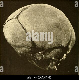 Moderne Diagnose und Behandlung von Krankheiten der Kinder; eine Abhandlung über die medizinischen und chirurgischen Erkrankungen der Kindheit und Kindheit der Kindheit. Rig. 1.-Seitenansicht der Möwe (mit Ante-Rior-Fontanelle und den frontalen, koronalen und sagittalen Nähten).(Grandiii, Jarman und Marx.) erforderlich, sollte Inspektion, Palpation, Auskultation, Schlagwerk, Mensurierung und Wiegen umfassen. Wir beginnen normalerweise mit der Untersuchung des Kopfes, wobei wir dessen Größe und Form, den Zustand der Knochen der 4 UNTERSUCHUNG DES PATIENTEN beachten: Schädel, seine Fontanellen und Suturen, seine Haltung, Gesichtsausdruck und Farbton; die Stockfoto