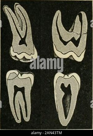 Transaktionen der Illinois State Dental Society, 1892 . Platte v.First Molars, Superior und Inferior. Platte VI. Zweite Molaren, Superior und Inferior. 118 ILLINOIS STATE DENTAL SOCIETY. Die Kronen aller Zähne oder jener Teil über der Ingivalline sind mit dieser Substanz bedeckt und geschützt, die als Emaille weiß und mit einem dünnen Rand an der Zahnfleischlinie beginnt. Stockfoto