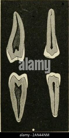 Transaktionen der Illinois State Dental Society, 1892 . Platte II. Erste Bicuspide, Superior und Inferior. Platte I.Second Bicuspids, Superior und Inferior. Allgemeine Form, während die Schneidezähne und Höcker in dieser Ansicht die Form der Zapfen vorführen, ihre Basen rootward dargestellt, wobei sie sich mit thekonischen Wurzeln an oder etwa dem freien Rand des Zahnfleischs vereinen. Siehe PlattenI. Bis einschließlich VI. Stockfoto