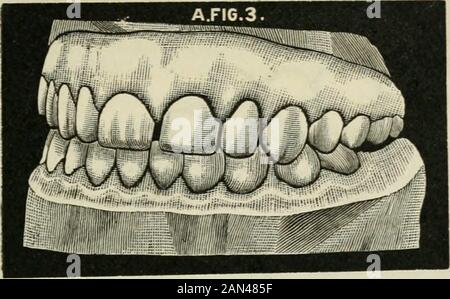 Transaktionen der Illinois State Dental Society, 1892 . KIEFERORTHOPÄDIE - EIN PRAKTISCHER FALL. 95. Stockfoto