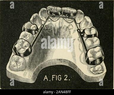 Transaktionen der Illinois State Dental Society, 1892 . KIEFERORTHOPÄDIE - EIN PRAKTISCHER FALL. 95 Stockfoto