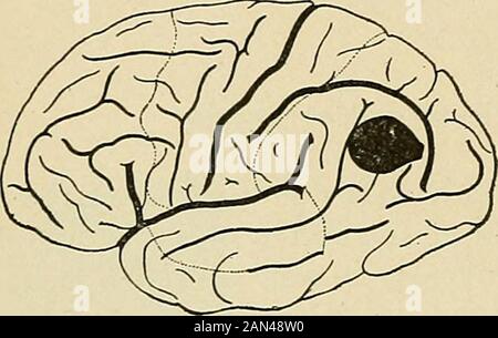 Organische und funktionelle Nervenkrankheiten; ein Textbuch der Neurologie . (Dejerine.) (Jfacewen.). Stockfoto