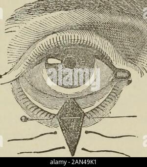 Handbuch der Augenheilkunde. TH thenormal Deckel. Zwei Einschnitte aus Arenow, die mit dem Messer durch die Haut geführt werden, wie in Abb. gezeigt. 35.Ihr Abstand zueinander am Deckelrand wird durch die Breite des zu erregenden Stücks bestimmt; sie konvergieren, wenn sie auf der Wange auf einen Punkt etwa 10 mm absteigen. Das zu überwingende Thebeep wird dann von den Pinzetten erfasst, eine Klinge wird auf die Haut gelegt, die andere auf die Bindehaut. Eine Klinge der geraden Schere wird dann in die Wunde und die andere Klinge in den Bindehaut gelegt, und die Gewebe, die von ihnen eingeschlossen werden, werden zuerst an arecut Stockfoto