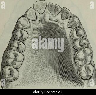 Die Zahnmedizinische Kosmos. Bei 77.-Abb. 24. Master L., Alter 13 Jahre, Nationalität, Amerikanische. Höhe der Gewölbe, .62 Zoll. Er atmete über den Mund in den vergangenen sechs Jahren. Es gibt beträchtliche Verhaftung von Ent- wicklung der Knochen der Nase. Das linke Nasenloch hat collapsedand das rechte Nasenloch teilweise, so dass der Patient throughthat Seite nur atmen kann, und mit Schwierigkeiten. Abb. 24.. Wie beobachtet werden, der Kiefer ist in diesem Fall gut entwickelt. Theforward Bewegung ol die Schneidezähne durch völlig auf eine lokale Ursache, Steuerung gespeichertenfahrzeugtyp Irritationen, die durch die unteren Zähne gegen die Stockfoto