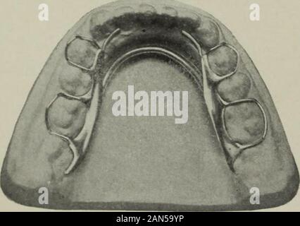 Die Zahnmedizinische Kosmos. sehr groß, und die Wangenknochen Promi-nent. Der obere Bogen war breit und theincisors nach innen gekippt. Die untere archwas Schmal, die backenzähne auf der linken Seite passgenau der Zweiten Molaren auf der rechten sideclosing ganz in der Linie der oberen. Die Schneidezähne sind extrudiert, Sticheln gegen das Zahnfleisch zurück der oberen Schneidezähne. Da der Patient incentral New York lebte, und erforderlichen Eighthours Zeit mein Büro zu erreichen, Er couldtherefore nur Besuche machen bei langen Inter-Vals. Die unteren Bogen wurde zum ersten Mal erweitert Lat allgemein mit einem expandierenden Gerät als Verwaltungsseite in Abb. 14. Das Gerät wa Stockfoto