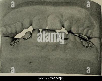 Die Zahnmedizinische Kosmos. e, wenn fort, würde die Zähne von der linken Seite der Bogen nach außen bewegen, verdirbt die gute occlu-sion, die auf der anderen Seite existierte. Zu diesen Bedingungen kommen, ein Apparat wasconstructed wie in der Abb. gezeigt. 5. Theusual Gerät mit einem mehrsprachigen base-Kabel für den Ausbau der unteren Bogen wasfirst gemacht. Der Biss war eröffnet, die anchorageportion bybuilding mit Metall der Geräte zur sidesufficiently Links die erhöhten Molaren auf der rechten Seite zu ermöglichen. In additionto-Teil auf der linken Seite a Metallflansch zur in befestigt war - Rillen Die anchora Stockfoto
