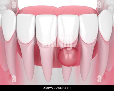 3D-Render von Kiefer mit Zyste auf Zähne root auf weißen Hintergrund. Zahnmedizinisches problem Konzept. Stockfoto