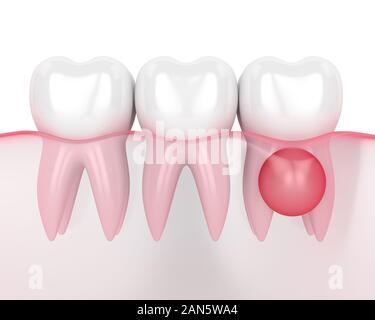 3D-Render der Zähne im Zahnfleisch mit Zyste auf root auf weißen Hintergrund. Zahnmedizinisches problem Konzept. Stockfoto