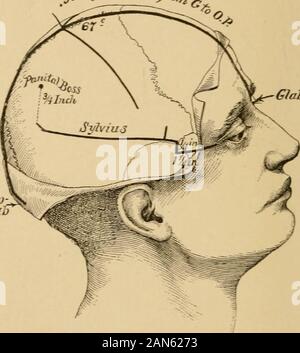 Gehirnchirurgie. Ftg. 7.-Foto von einer Besetzung von einer Leiter, die das Verhältnis der CranialSutures auf die zerebrale Fissuren und Windungen. F, Frontale; P, Parietale; O, occi-Pital; T, Schläfenlappen, S, Riss des Sylvius; J?, Riss des Rolando; J, inter-parietale Fissur; P O-, Parieto-Okzipitalen riss; EIN B, anterioren und posterioren centralconvolutions. entfernt, da die notwendigen Symptome zu determineits Ort nicht vorhanden sind. 14 GEHIRNCHIRURGIE. Es gibt andere Fälle, in denen es offensichtlich ist, dass die Erkrankung, die tief in den Hemisphären oder auf Basis des Gehirns vollständig über die Rea befindet. Stockfoto