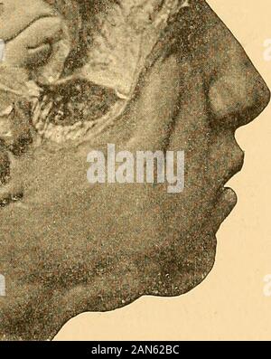 Gehirnchirurgie. j*. Ftg. 7.-Foto von einer Besetzung von einer Leiter, die das Verhältnis der CranialSutures auf die zerebrale Fissuren und Windungen. F, Frontale; P, Parietale; O, occi-Pital; T, Schläfenlappen, S, Riss des Sylvius; J?, Riss des Rolando; J, inter-parietale Fissur; P O-, Parieto-Okzipitalen riss; EIN B, anterioren und posterioren centralconvolutions. entfernt, da die notwendigen Symptome zu determineits Ort nicht vorhanden sind. 14 GEHIRNCHIRURGIE. Es gibt andere Fälle, in denen es offensichtlich ist, dass die Erkrankung, die tief in den Hemisphären oder auf Basis des Gehirns ganz jenseits der befindet. Stockfoto