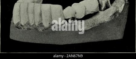 Die Zahnmedizinische Kosmos. Fall V. untere Kampf Seite nach der Behandlung. Abb. 18. Fall V Feigen. 17 und 18 zeigen den Zustand der unteren Zähne eines Patienten unter Behandlung. Fall V. Unten links nach der Behandlung. Abb. 19. Stockfoto