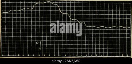 Die Grundsätze und die Praxis der Hydrotherapie: ein Leitfaden für die Anwendung von Wasser in Krankheit für Studierende und Praktiker der Medizin. ve produziert (wie in Abb. 1 gezeigt. 1) registriert wurde während der gesamten timewith, interrup- tion. Es zeigte aneven skizzieren, so lange die Wanne war leer. So schnell wie die waterwas gegossen in, wie bei einem gezeigt, die Kurve stieg senkrecht. Thevolume der Arm muss deshalb zu, weil sich die waterused in die Manometer angetrieben worden sein müssen. Dieser Effekt continuedfor achtzehn bis zwanzig Sekunden, und die Linie fiel leicht während der folgenden Zwanzig zum Th Stockfoto