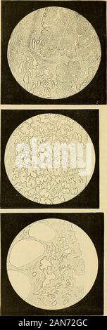 Die Diesem Der Frauen Fur Arzte Und Studierende Hst Die Hintere Scheidenwand Ange Drangt Und Fangt Durch Hebelbewegungen Am Unteren Grosseren Ringedie Portio Im Oberen Kleineren Dann Touchirt Mann Unter Dem Pessar Ob alamy