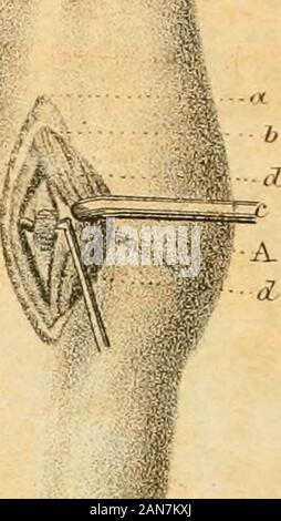 Ein Handbuch der militärischen Operation, für die Verwendung von Chirurgen in der Confederate States Army; mit erläuternden Platten aller nützliche Funktionen ausführen. W%, A, Platte 18. Abb. 1. - die Beziehungen der posterior tibial Artery, A, zwischen thesuperficial und tiefen Schichten der Muskeln auf der Rückseite des Beines liegen, coveredin der oberen Hälfte der Kurs von 9, der Gastrocnemius und Soleus mus-cles und liegen bei 8, die Gemeinsame flexor der Zehen. In der lowerpart des Beines posterior tibial Arterie zwischen 6 Lügen, die Tendo achil-lis, und 7, die gemeinsame flexor der Zehen, die separaten das Schiff ausdem Gesicht der Stockfoto