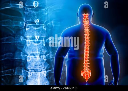Ansicht von hinten von einem beleibten Mann mit seiner Wirbelsäule oder Backbone und Wirbel x-ray im Hintergrund. Übergewicht und Verletzung zurück 3D Rendering Illustration. Zurück Stockfoto