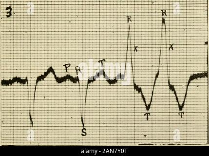 Physiologie und Biochemie in der modernen Medizin. Abb. 86,- Congelador extrasystole. Zwei congelador cxtrasystoles folgende zwei normale Komplexe. Hinweis die ektope Ursprung Der extrasystolen durch die Invertierung von S. angegeben. Abb. 87. ventrikuläre Extrasystolen im rechten Ventrikel ergeben. Stockfoto