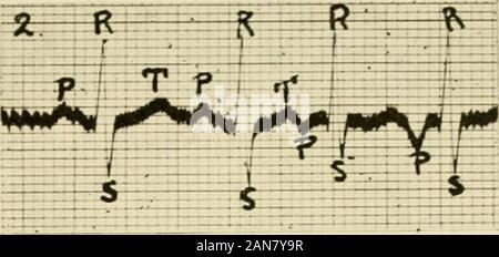 Physiologie und Biochemie in der modernen Medizin. Abb. 85.- sinusbradykardie. Kate 32 pro Minute. Hinweis Die normalen Erscheinungsbild der Elektro-Elektrokardiogramm. P-R-Intervall = .17 Sekunden.. Abb. 86,- Congelador extrasystole. Zwei congelador cxtrasystoles folgende zwei normale Komplexe. Hinweis die ektope Ursprung Der extrasystolen durch die Umkehrung des s. Stockfoto