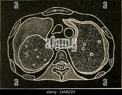 Die ärztliche Untersuchung über die Lebensversicherung und die damit verbundenen klinischen Methoden: mit Kapiteln über die Versicherung von minderwertigen Lebens- und Unfallversicherung. Abb. 60.- Pneumothorax (Links) und verkapselte Flüssigkeit (rechts). Abb. 6 Ich.- Pleuraerguss. Besondere Aufmerksamkeit sollte der komprimierte Lunge in den größeren Erguss gerichtet werden. Die l Wll ich ICH DER L I 111 Brust l i? Ich. (Nicht Stockfoto