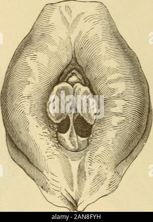 Real-Encyclopädie der gesammten Heilkunde; medicinisch-chirurgisches Handwörterbuch für praktische Ärzte. RingförmigerHymen, Septus.. Stockfoto