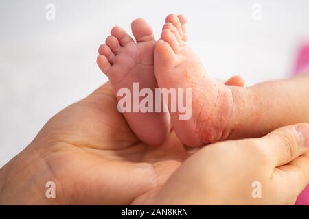 Kleinkind Beine mit trockener Haut. Allergie leiden von Milch Formel oder andere Lebensmittel. Closeup. Shot Stockfoto