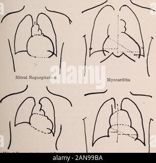 Albany Medical Annalen. Schematische Orthodiagram des Herzens Aortenklappeninsuffizienz (Normal). Mitralinsuffizienz und Stenose; Aortenklappeninsuffizienz Dilatation der Aorta 34° RÖNTGEN STRAHLEN BEI DER UNTERSUCHUNG der Brust, Lunge kann manchmal ohne spürbare Zeichen existieren, denn der darüberliegenden gesunde Luft Vesikel. In Emphysem die Luft Vesikel werden mehr durchlässig für die X-Raysand sind daher Hyper-transparent. In der Tuberkulose die con-glomerate Tuberkel Runde werfen Schatten auf den in der Regel clearareas der Lunge, während die verstopften Arterien und Venen, infil Formel lymphatics und bronchiolen, die zu Stockfoto
