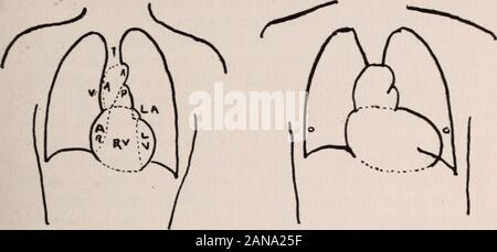 Albany Medical Annalen. Schematische Orthodiagram des Herzens Aortenklappeninsuffizienz (Normal). Mitralinsuffizienz und Stenose; Aortenklappeninsuffizienz Dilatation der Aorta 34° RÖNTGEN STRAHLEN BEI DER UNTERSUCHUNG der Brust, Lunge kann manchmal ohne spürbare Zeichen existieren, denn der darüberliegenden gesunde Luft Vesikel. In Emphysem die Luft Vesikel werden mehr durchlässig für die X-Raysand sind daher Hyper-transparent. In der Tuberkulose die con-glomerate Tuberkel Runde werfen Schatten auf den in der Regel clearareas der Lunge, während die verstopften Arterien und Venen, infil Formel lymphatics und bronchiolen, die zu Stockfoto