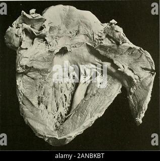 Studien der kardialen Pathologie. xperimental Nephritis produziert von Kälte, adren-alin in erhöhten Mengen im Blut sofort der Nachfolger des coldbath gefunden ist, dass vielleicht diese Substanz ist die Ursache der Hypertonie in den frühen Stadien der Krankheit. Hypertrophie bei herzklappenfehler Krankheit. - Die myokardiale changeswhich folgen Sie der experimentelle Teil der Aorten- und tricuspidvalves deuten auf eine mechanische und nicht um eine entzündliche Ursprungs. Die primäre Dilatation, folgt der Operation produziert erste Bronowski: Presse M6 dicale, 1904, Nr. 99.2 Alwen: Deut. Arch. f. klin. Med., xcvi Stockfoto