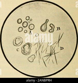Praktische Physiologische Chemie; ein Buch für den Einsatz in Kursen in praktische Physiologische Chemie in Schulen der Medizin und der Wissenschaft entwickelt. Abb. 64.-.4, intakte unverdaute Fleisch Abb. 65.- ein, neutral Fat; B, iatty Säure Fasern; B, teilweise verdaute Fleisch Fasern; durch Essigsäure befreit; C, Seifen; D, Fettsäure C, fast vollständig verdaut Fleisch säure Kristalle, Fasern. Stockfoto