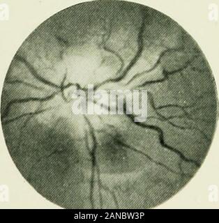 Ein Essay über die Geschichte der Elektrotherapie und Diagnose;. Fotos des Fundus oculi, von Professor WertheimSalomonson, von Amsterdam übernommen. 1. Normal. 2. Diabetiker chorio Retinitis. 3. Optic Atrophie [Disseminierte Sklerose). 4. Erstickten Disc [Hirntumor). 5. Übersicht myelinisierter Fasern. 6. Retinitis, Optikusneuritis [Sypliilitii Meningitis). K130 EIN ESSAY ÜBER DIE Stockfoto