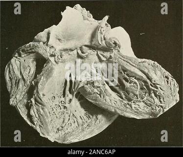 Studien der kardialen Pathologie. y ist insignifi - kann nicht im Vergleich zu dem, was Ma.y im Ventrikel neverthelessan auftreten, erhöhen Sie die Dicke von 3 cm. Wurde beobachtet.^ Atrophie Quenus: Diese de Paris, 18 S3, S. 42. - Pitt, bei Jungs Krankenhaus, gefunden, daß Mitralklappenstenose drei Mal so oft inassociation mit eingeschränkter Sklerose wie in anderen Krankheiten aufgetreten ist, und dass zwei Drittel der Fälle treten inwomen. Tripier: Bogen, de MM. Das Fachleute., ISSS. * Potain: Jour de Med. et de Chir. Prat., 1891. 5 Teissier: Diese de Paris, 1894. Sears (St. Paul Med. Jour., März, 1907) gefunden, gut markierten Tuberkulose in 11 oder Stockfoto