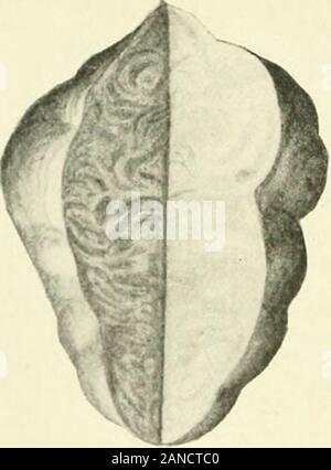 Myome und alliierten Tumoren (Myome und adenomyoma): ihre Pathologie, klinische Merkmale und chirurgische Behandlung. Abbn. 157 und 158.- Übersicht pedunculated zervikalen submuköse Myome ((ibroid polypi). .. 1^?^^^^^^^X. Stockfoto