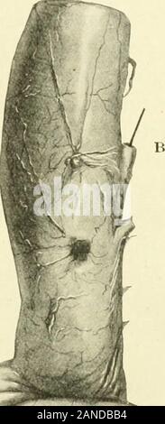 Myome und alliierten Tumoren (Myome und adenomyoma): ihre Pathologie, klinische Merkmale und chirurgische Behandlung. Stockfoto