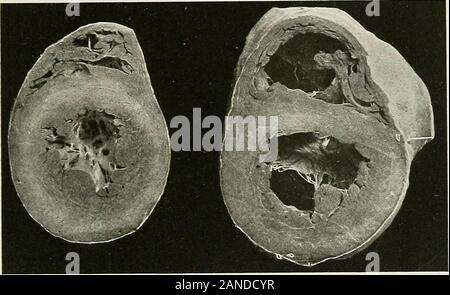 Erkrankungen der Brust und der Prinzipien der physischen Diagnose. Abb. 383.- Einfache Hypertrophie. {Jefferson Medical College Museum.). Abb. 384.-Hypertrophie und Dilatation. {Jefferson Medical College Museum.) Stockfoto